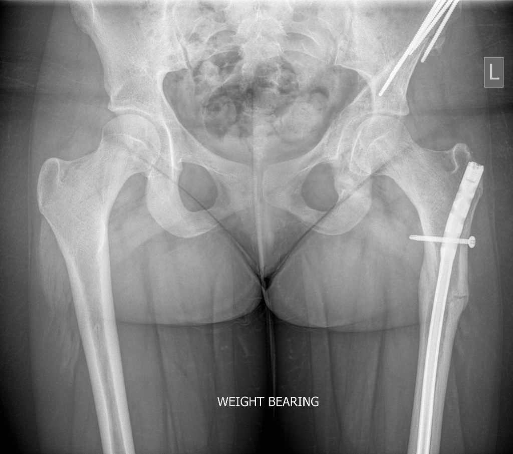 XR Femoral Osteotomy XR Femoral Osteotomy