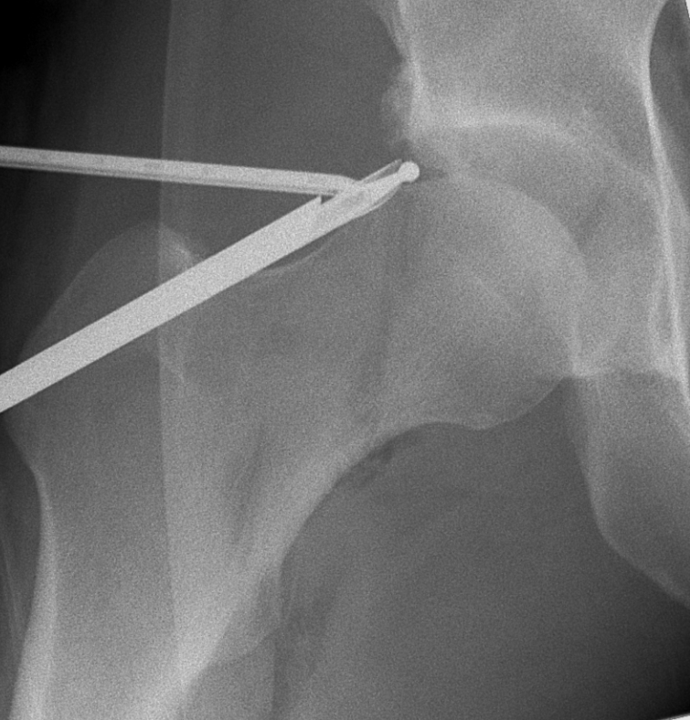II Hip Arthroscopy