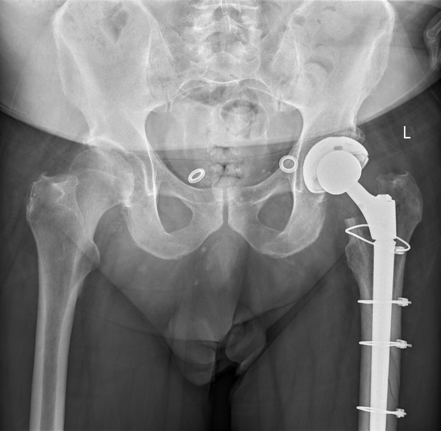 Revision Hip Replacement