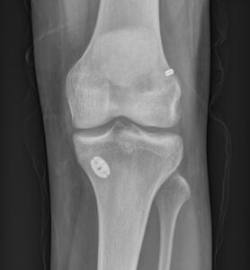 Xray ACL Reco