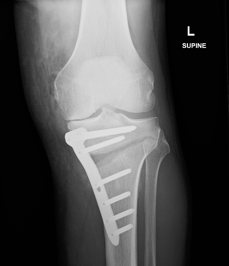 Xray HTO Xray HTO