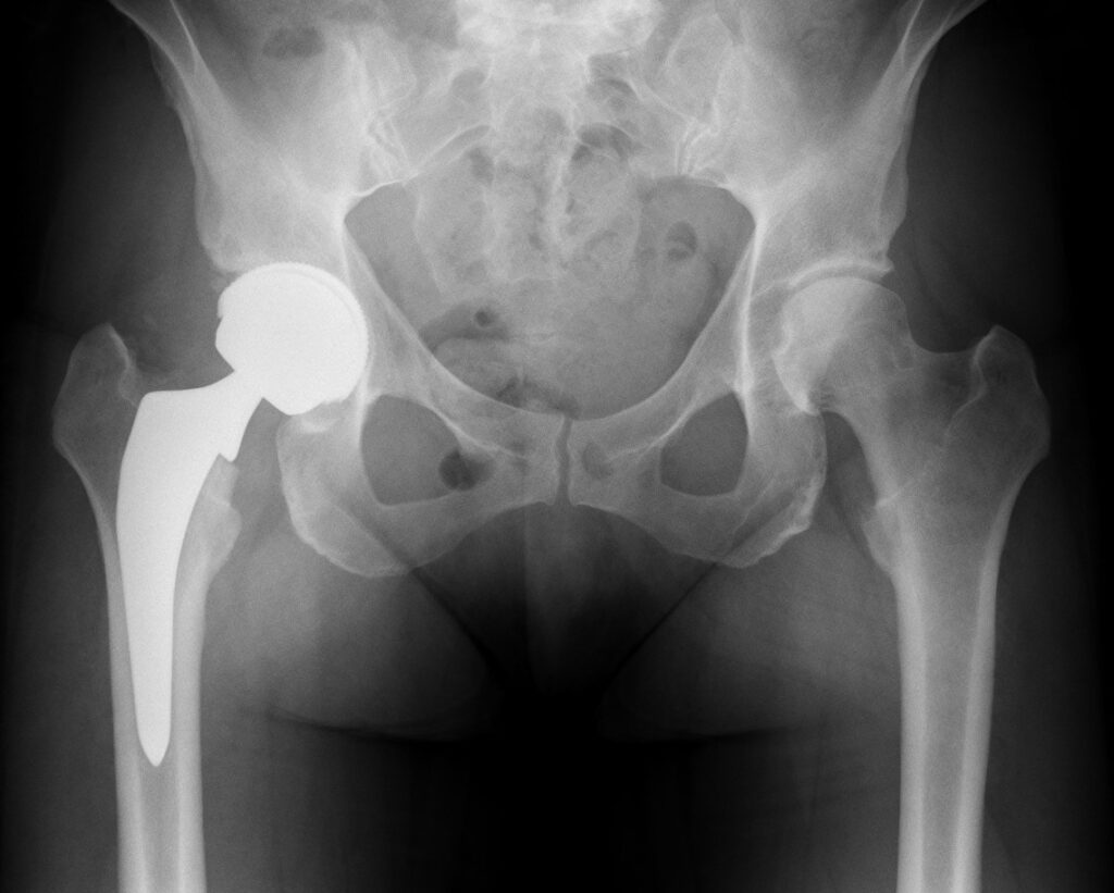 Xray Hip Replacement