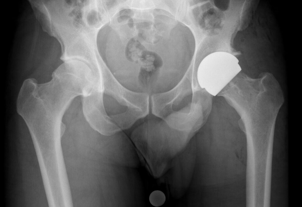 Xray Hip Resurfacing Xray Hip Resurfacing