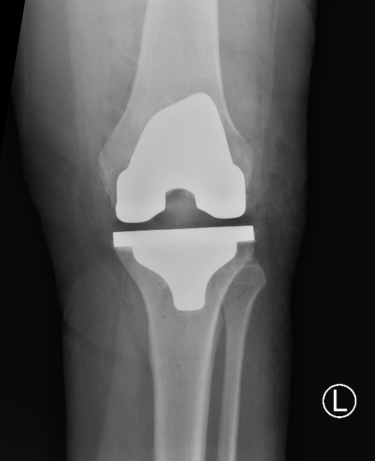 Xray Knee Replacement Front Xray Knee Replacement Front