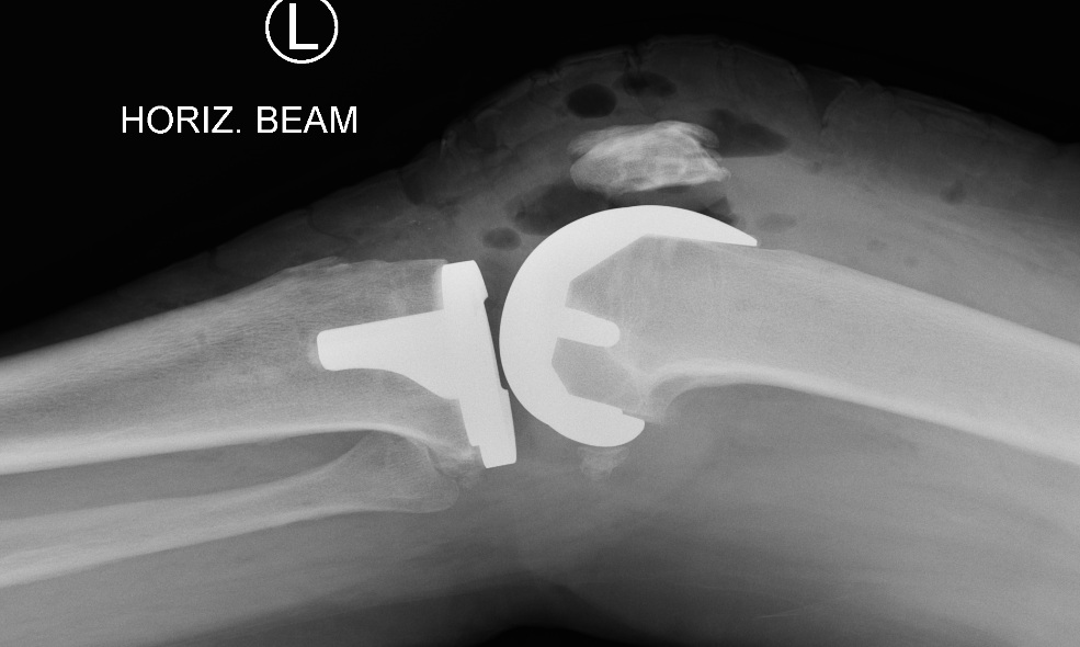 Xray Knee Replacement Side Xray Knee Replacement Side