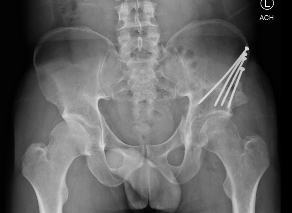 Xray PAO