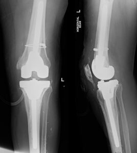 Xray Revision TKR