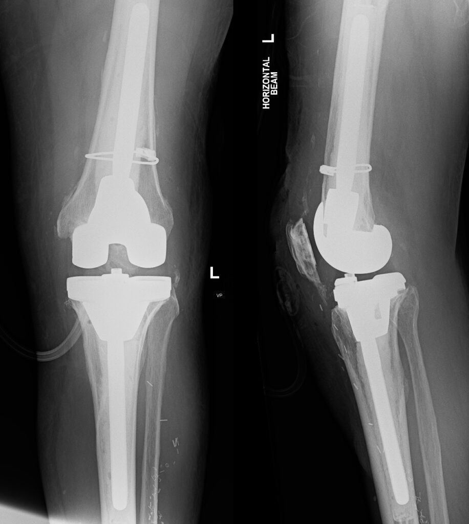 Xray Revision TKR